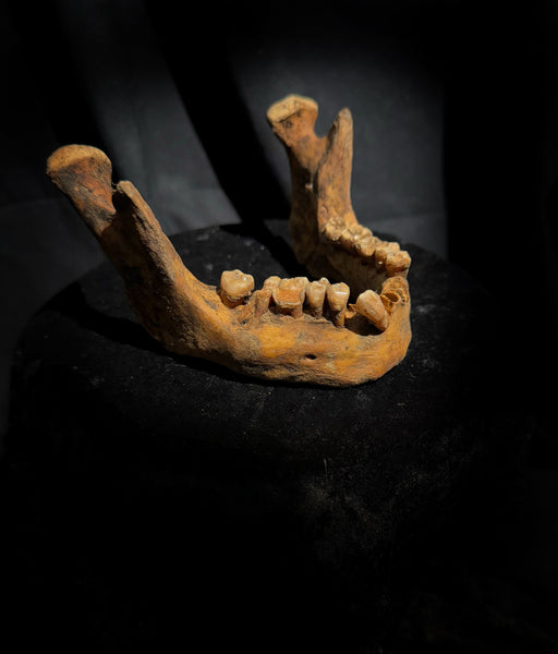 A mandible