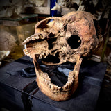 Human skull with bone cancer