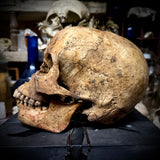 Human skull with bone cancer