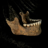 A mandible