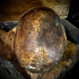 Human skull (bone cancer)