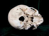 Child dwarf skull