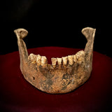A mandible