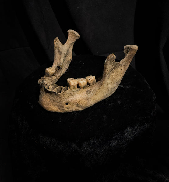 A mandible