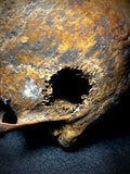 Item 23. Bone cancer skull