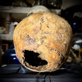 Human skull with bone cancer