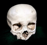 Child dwarf skull