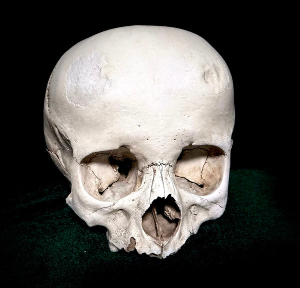 Child dwarf skull