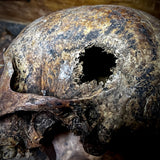 Human skull (bone cancer)