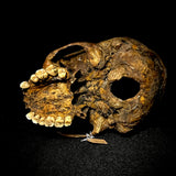 Item 23. Bone cancer skull