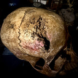 Human skull with bone cancer