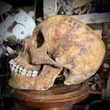 Human skull with mandible and brass teeth