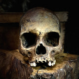 Human skull (bone cancer)