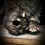 Human skull (bone cancer)
