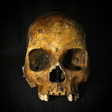 Item 23. Bone cancer skull