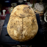 Human skull with bone cancer