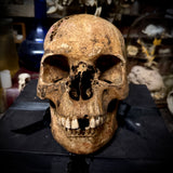 Human skull with bone cancer