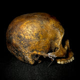 Item 23. Bone cancer skull