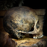 Human skull (bone cancer)