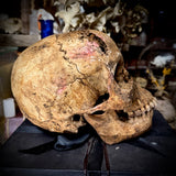 Human skull with bone cancer