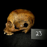 Item 23. Bone cancer skull
