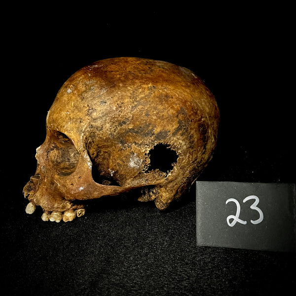 Item 23. Bone cancer skull