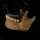 A mandible