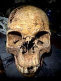 Human skull with bone cancer