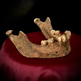 A mandible