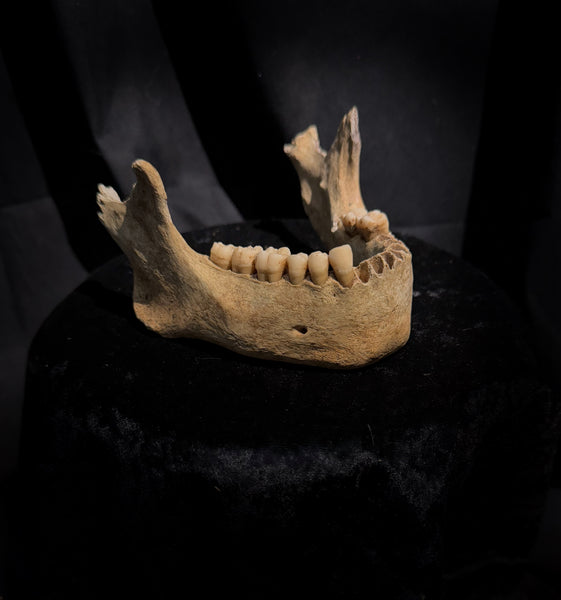 A mandible